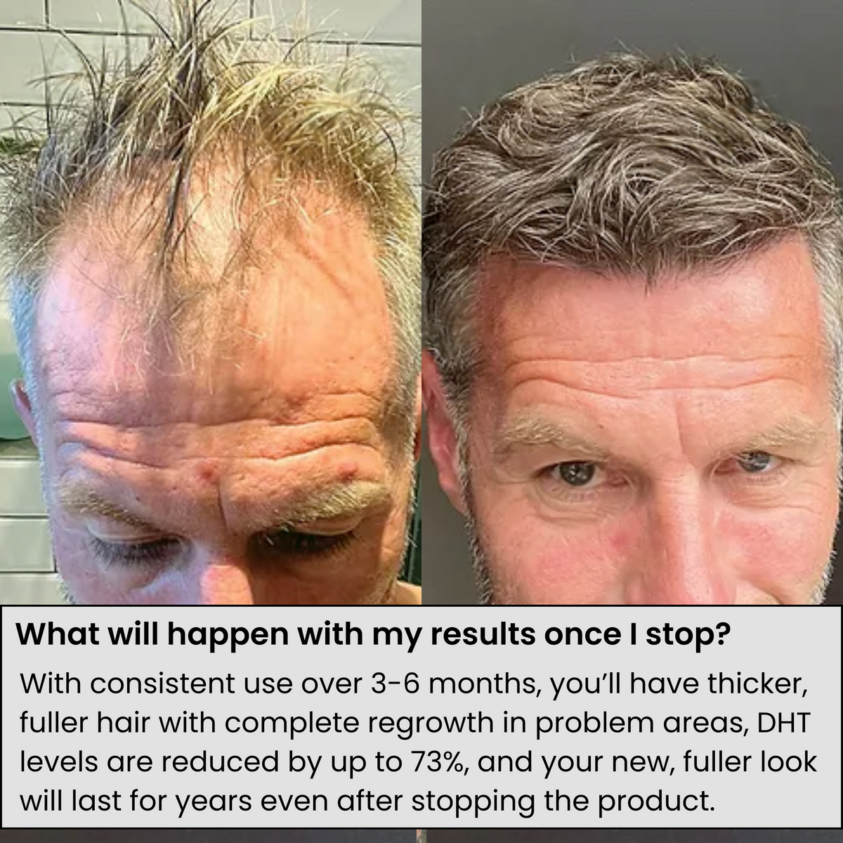 AlphaFusion™ Hair Regrowth System