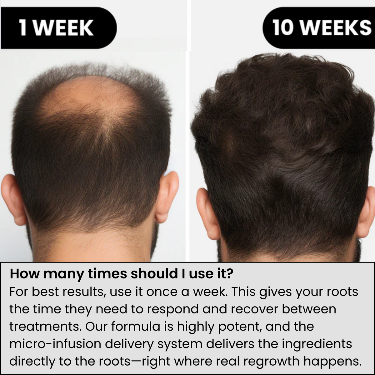 AlphaFusion™ Hair Regrowth System